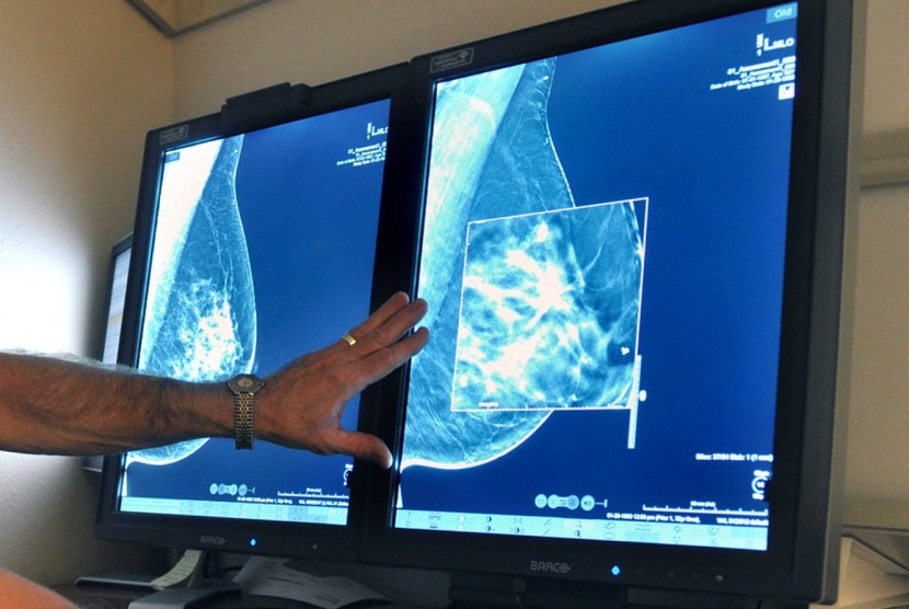 Mamografi (Ilustrasi). Selain faktor genetik atau keturunan, faktor hormonal serta gaya hidup tidak sehat bisa memicu kanker payudara.