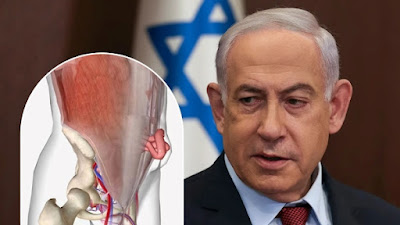 PM Israel Netanyahu dalam Kondisi Sadar Usai Operasi Turun Berok, Dipulangkan Selasa