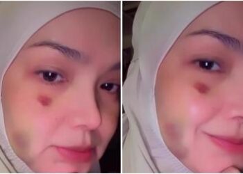 Geger! Wajah Siti Nurhaliza Penuh Lebam dan Biru-Biru, Ada Apa?