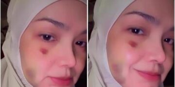 Geger! Wajah Siti Nurhaliza Penuh Lebam dan Biru-Biru, Ada Apa?